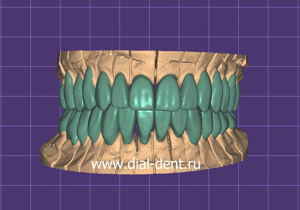 компьютерное моделирование зубных коронок