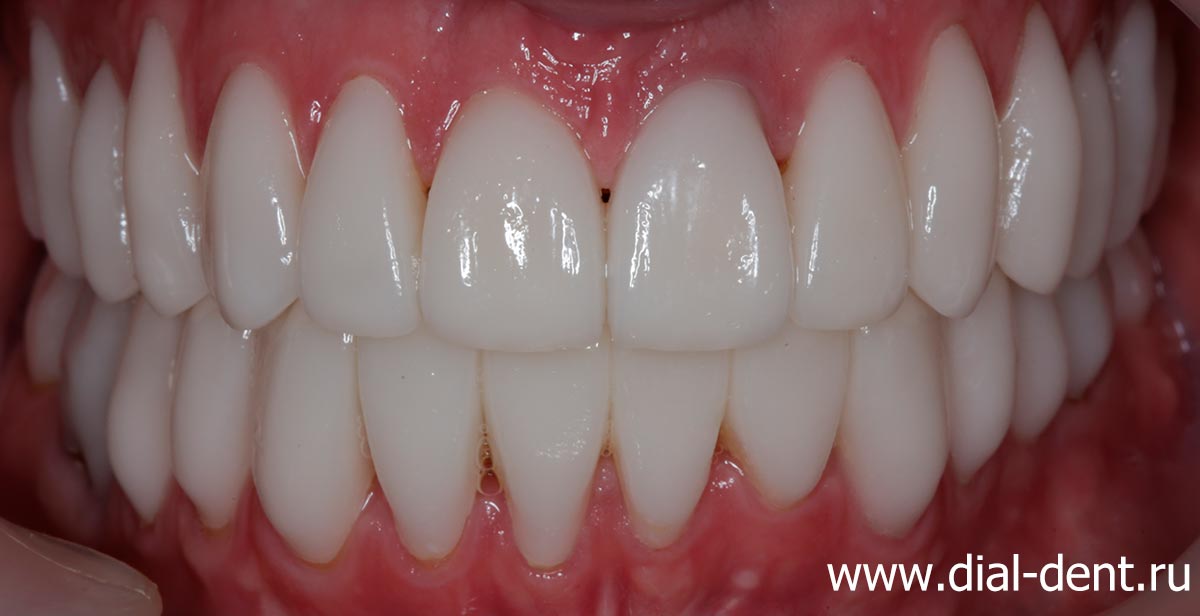 вид зубов после лечения и протезирования керамическими коронками