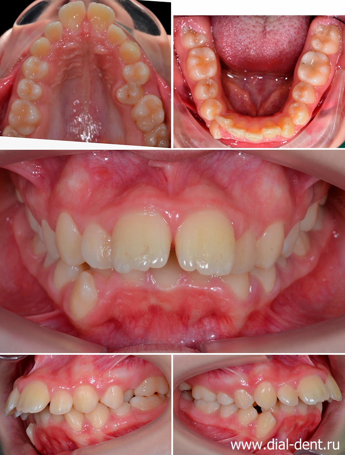 вид зубов до лечения у ортодонта