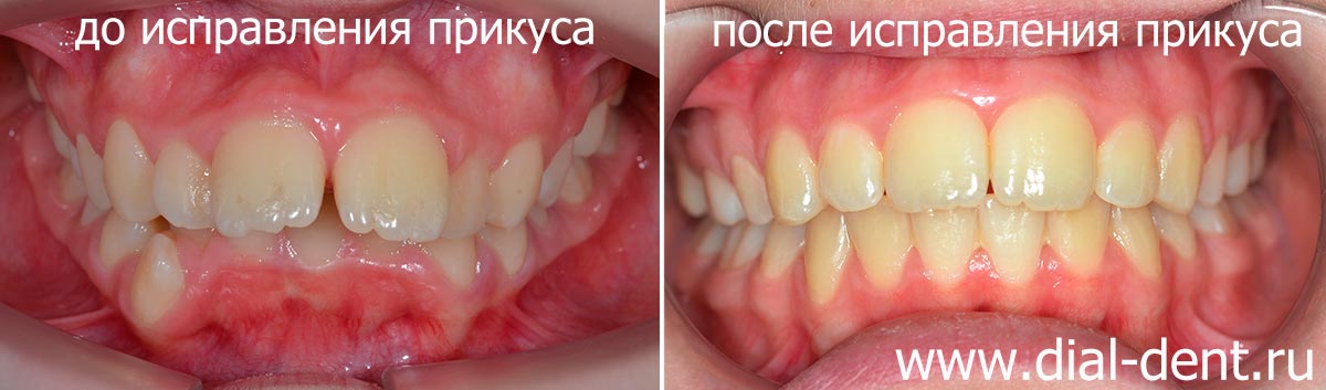 исправление прикуса брекетами с удалением зубов
