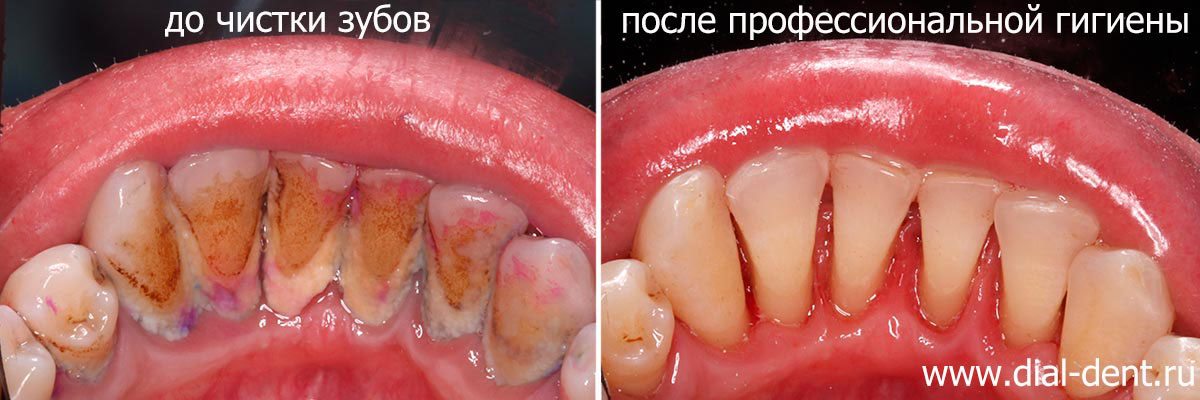 внутренние поверхности зубов до и после профессиональной гигиены рта