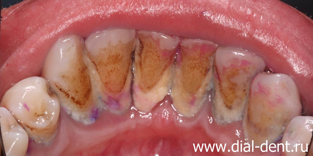 зубной налет и зубной камень на внутренней поверхности