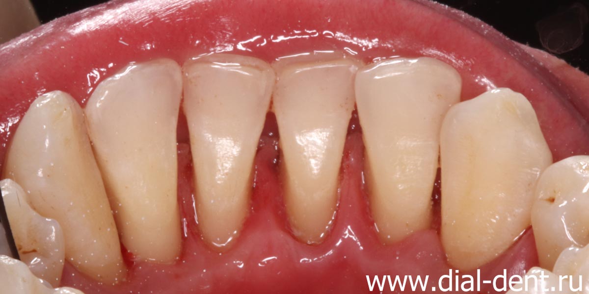 внутренние поверхности зубов полностью очищены от отложений