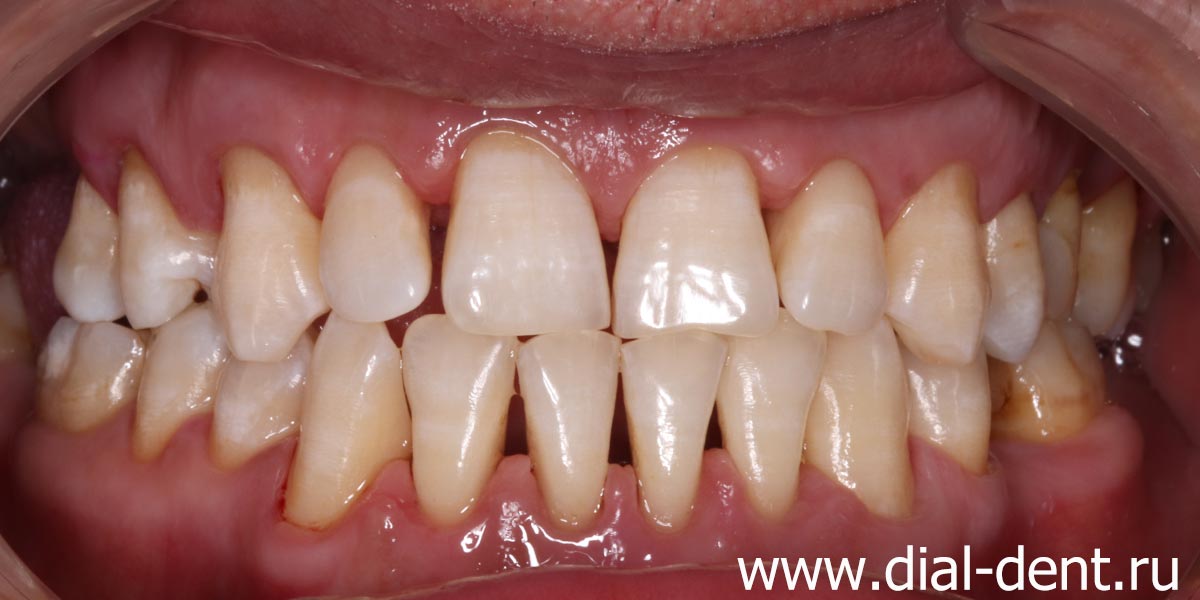 зубы чистые и гладкие после профессиональной гигиены