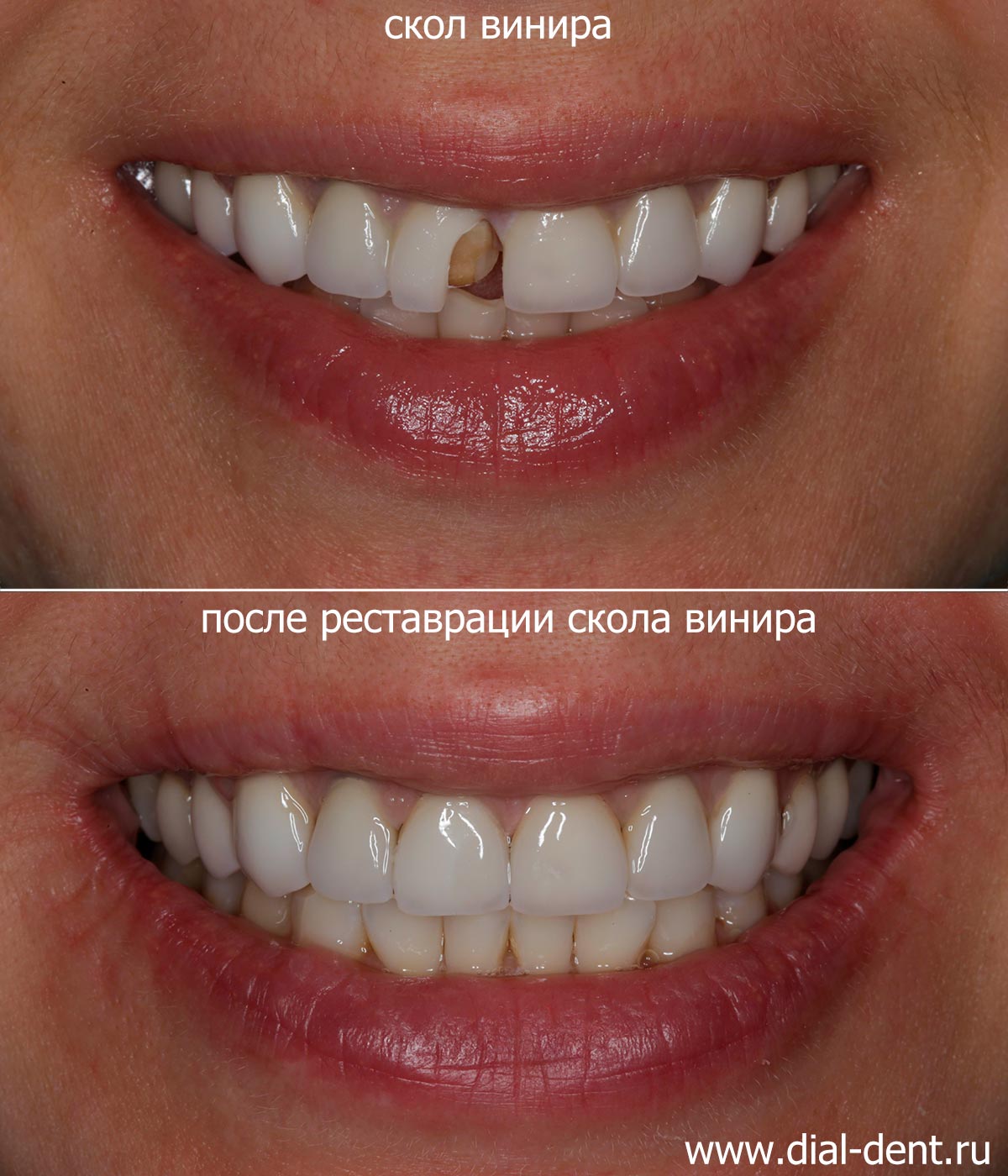 улыбка до и после реставрации скола винира на переднем зубе