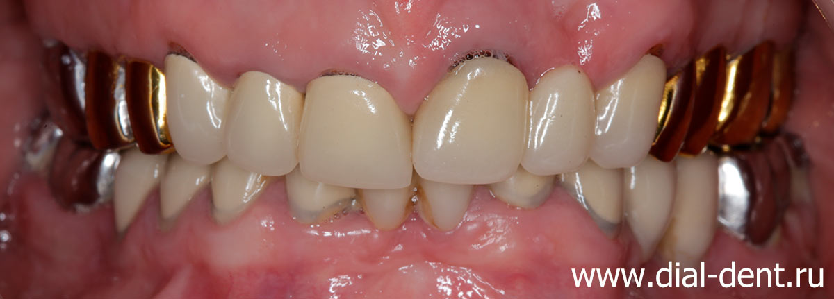 старые коронки, неэстетичный вид передних зубов, рецессия десны, боли в суставах