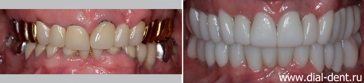 Функциональное протезирование зубов для здоровья суставов