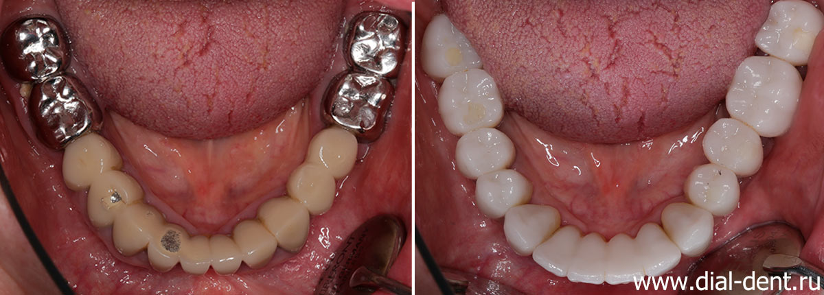 вид нижних зубов до и после протезирования керамикой в Диал-Дент