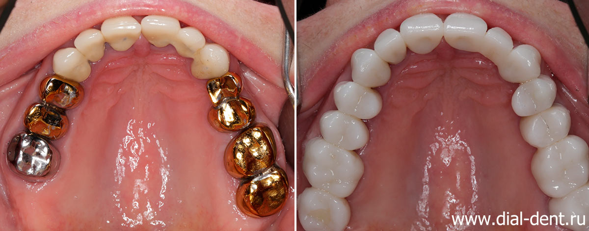 вид верхних зубов до и после протезирования керамикой в Диал-Дент