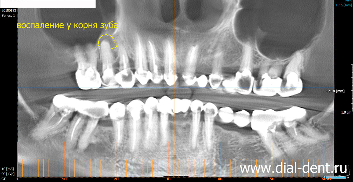 вокруг корня зуба видна область воспаления