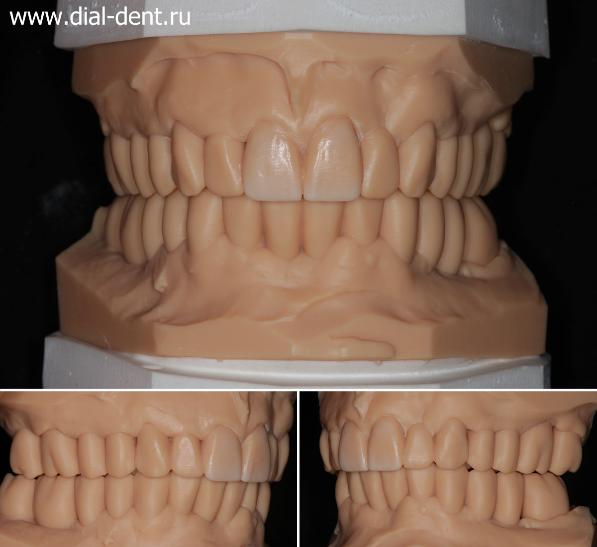 3D модель зубов на основании компьютерного моделирования