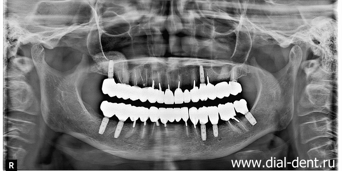 панорамный снимок зубов после имплантации и протезирования в Диал-Дент