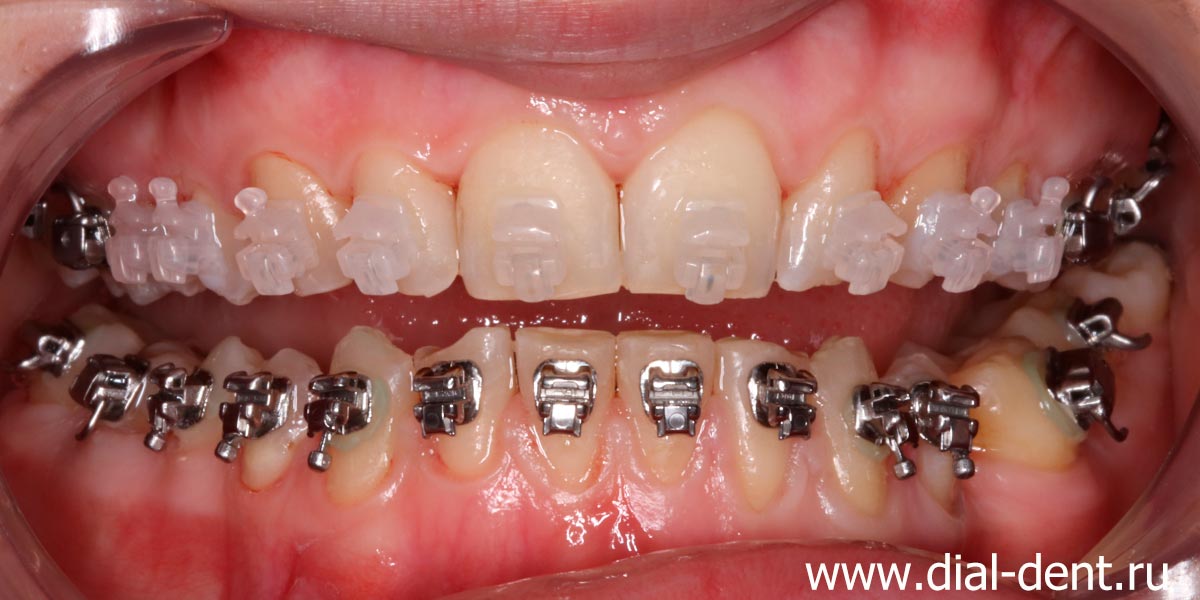 чистые зубы с брекетами после профессиональной гигиены рта
