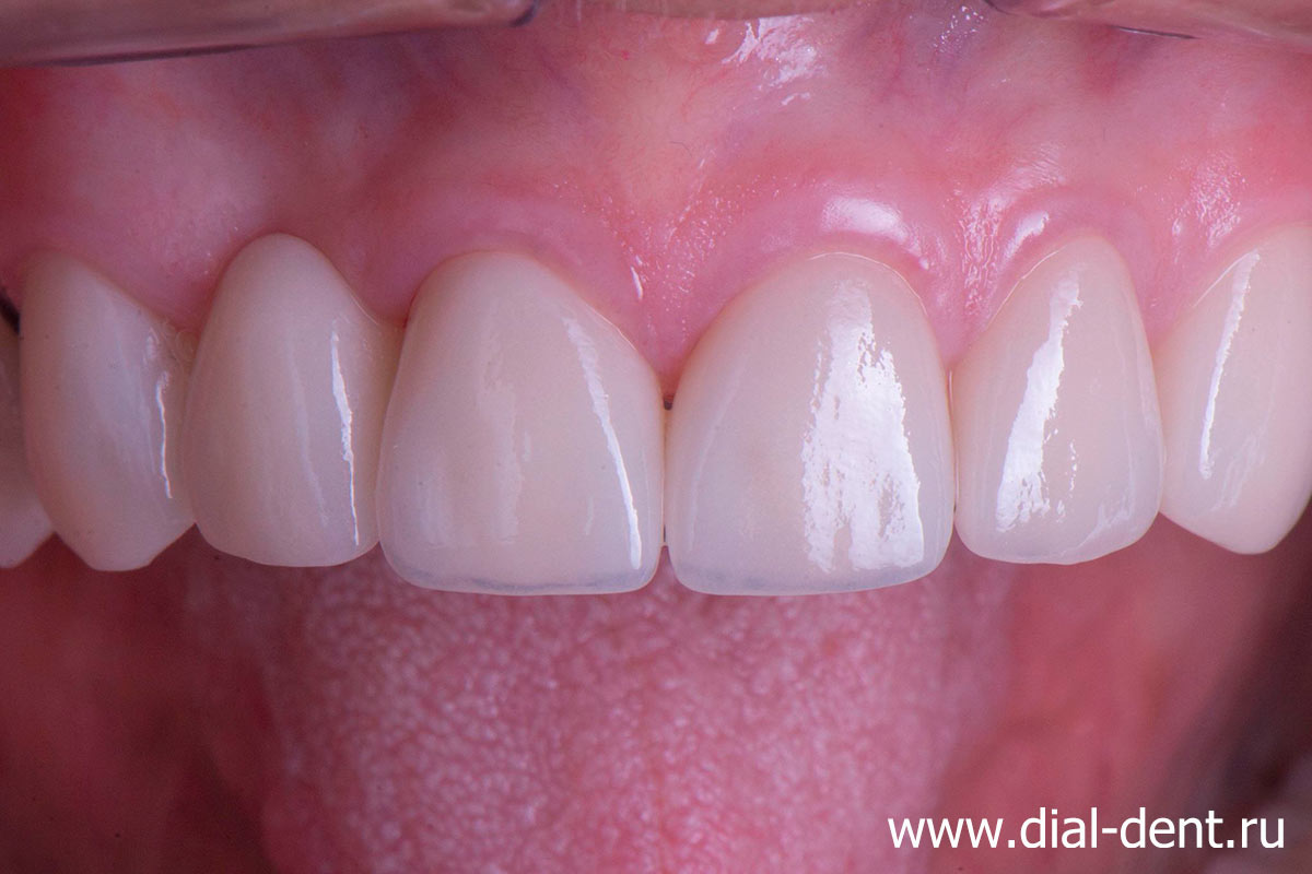 протезирование зубов коронками с мостовидным протезом переднего зуба