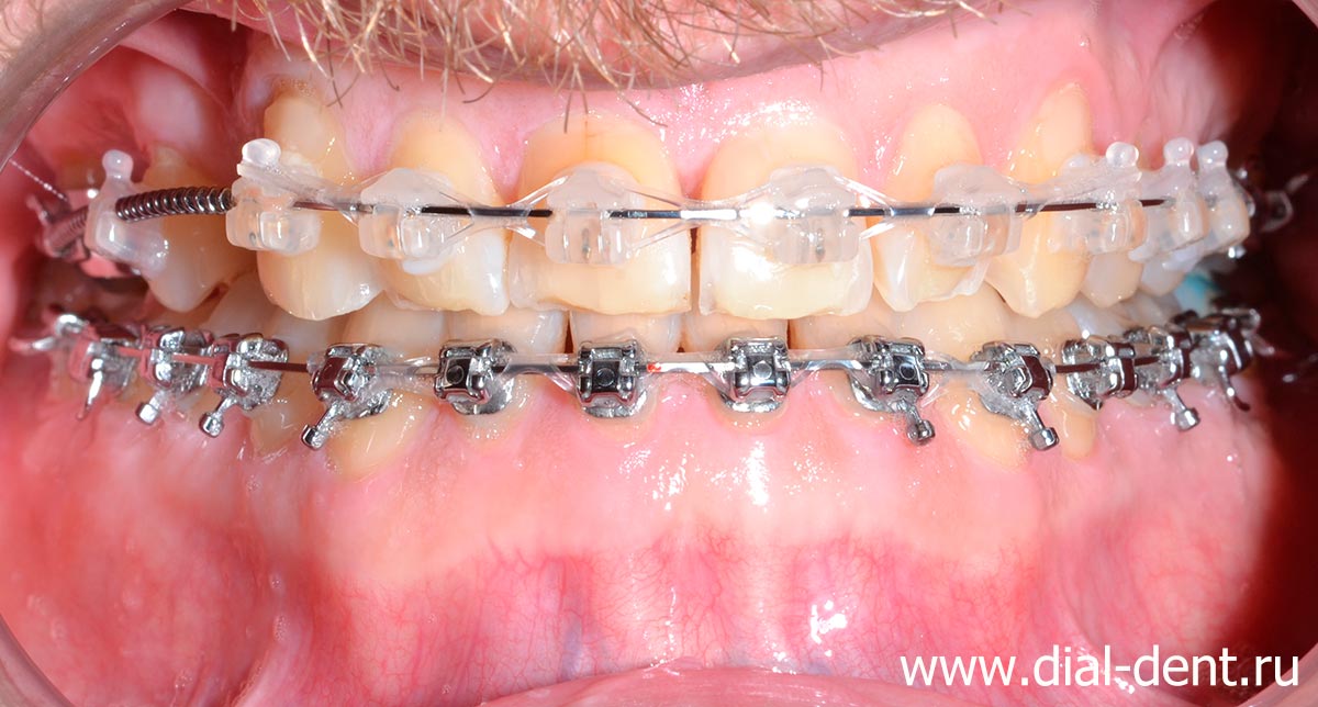 брекеты а зубах и ортодонтические эластики