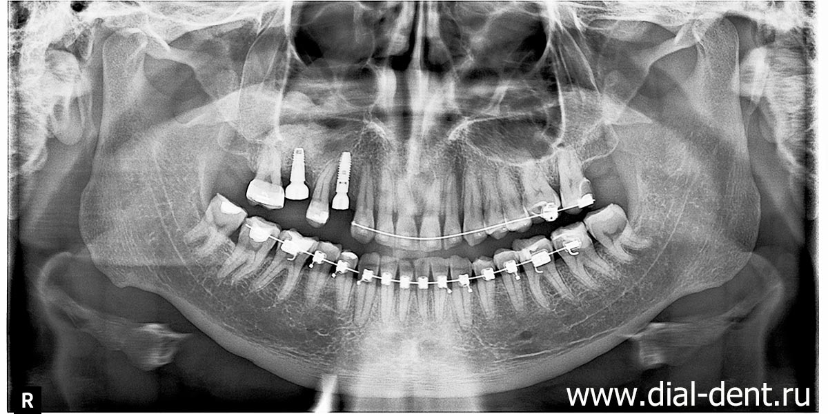 зубные импланты установлены за 4 месяца до снятия брекетов