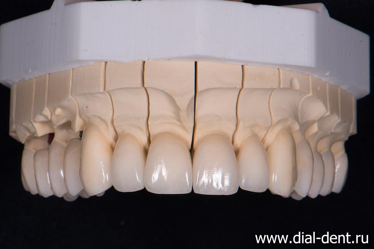 зубные коронки из керамики E.max и диоксида циркония