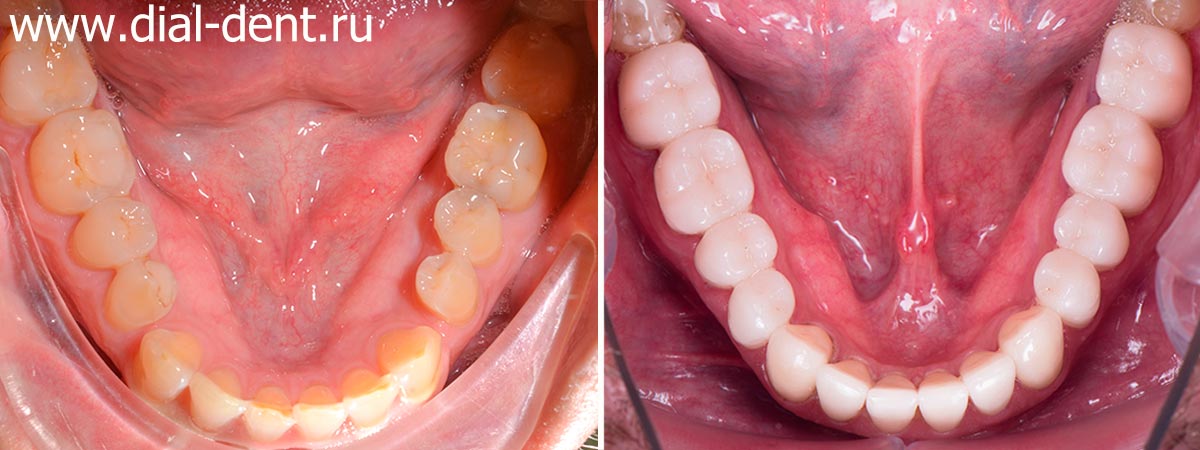 до и после комплексного стоматологического лечения в Диал-Дент
