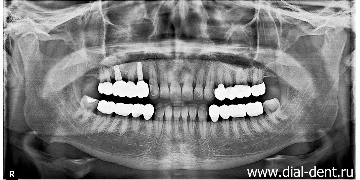 панорамный снимок после исправления прикуса, имплантации и протезирования зубов