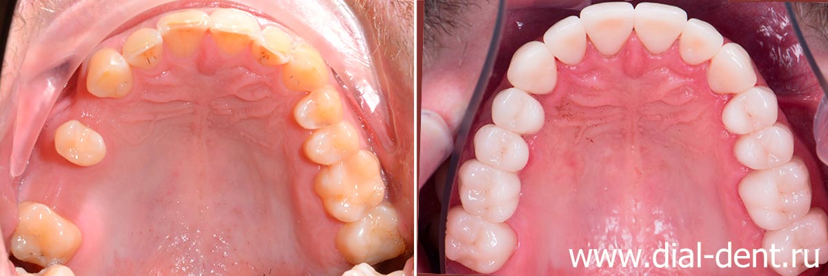 до и после комплексного стоматологического лечения в Диал-Дент
