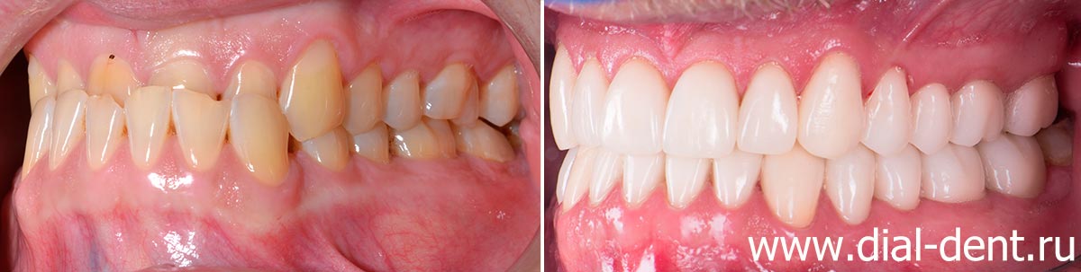 вид слева до и после комплексного стоматологического лечения в Диал-Дент