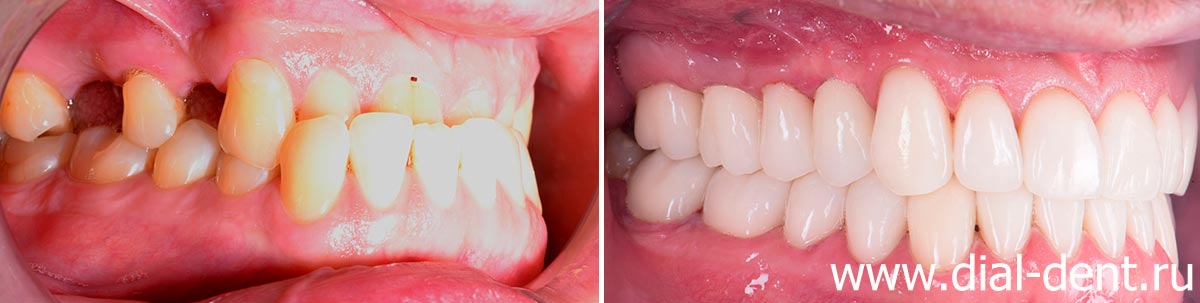 вид справа до и после комплексного стоматологического лечения в Диал-Дент