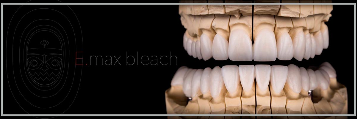 керамические коронки и виниры на модели зубов в лаборатории