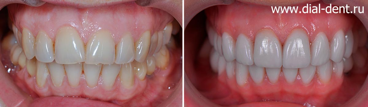 вид до и после протезирования зубов керамикой