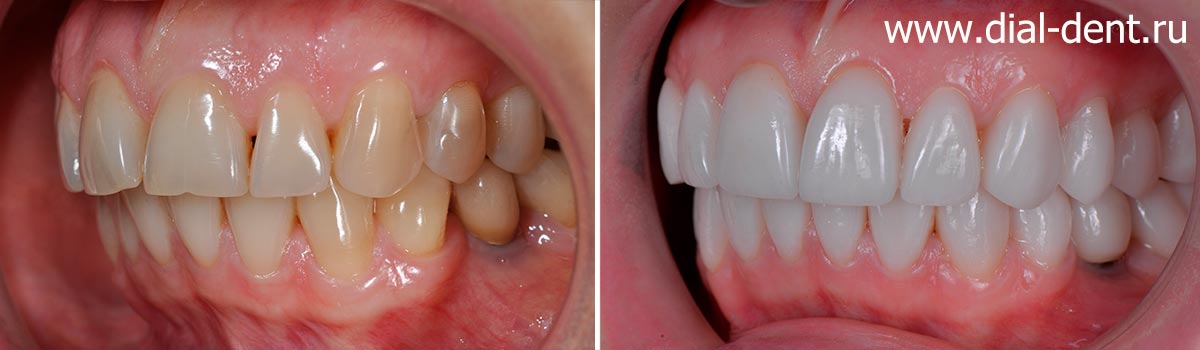 вид зубов слева до и после протезирования керамическими коронками и винирами