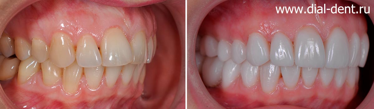 вид зубов справа до и после протезирования керамическими коронками и винирами