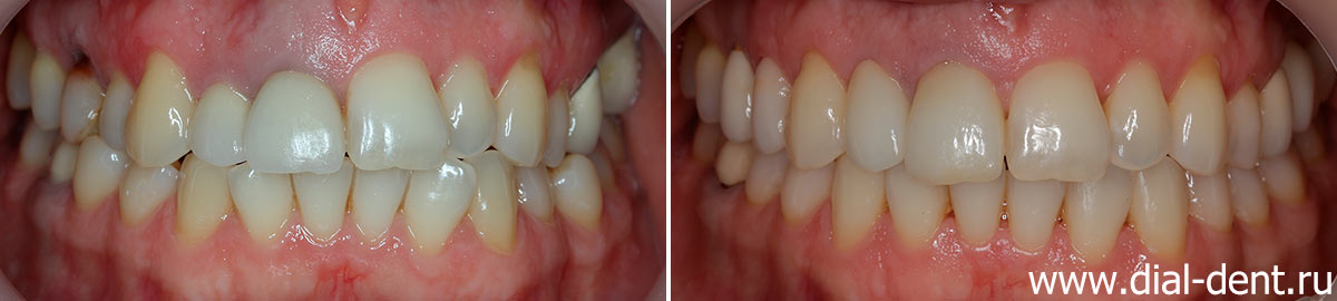 зубы до и после лечения и протезирования в Диал-Дент
