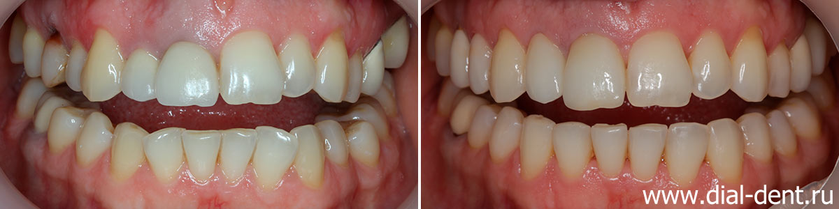 зубы до и после лечения в Диал-Дент