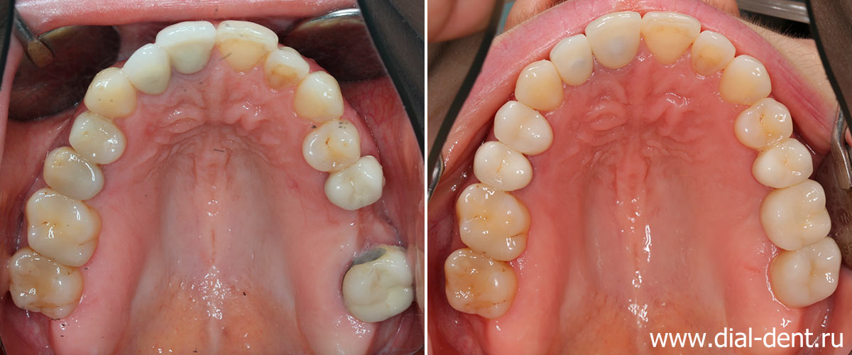 верхние зубы до и после лечения и протезирования в Диал-Дент