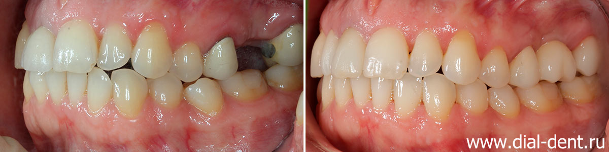 вид зубов слева до и после лечения