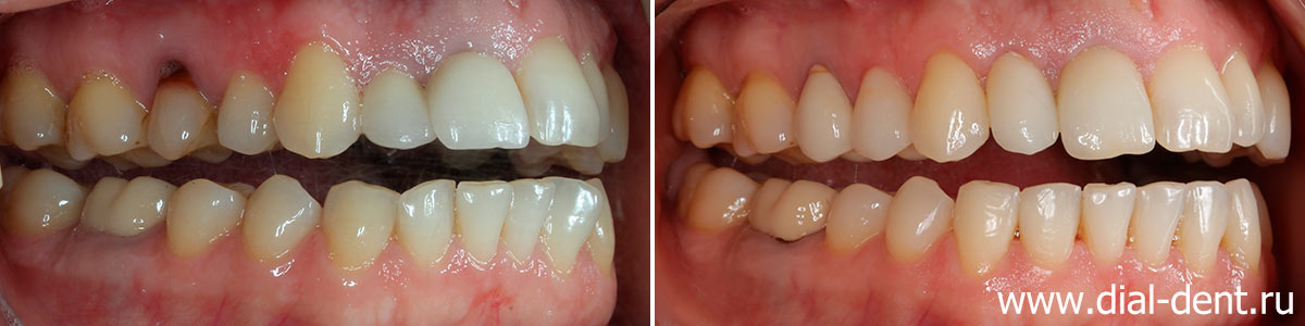 вид зубов справа до и после лечения