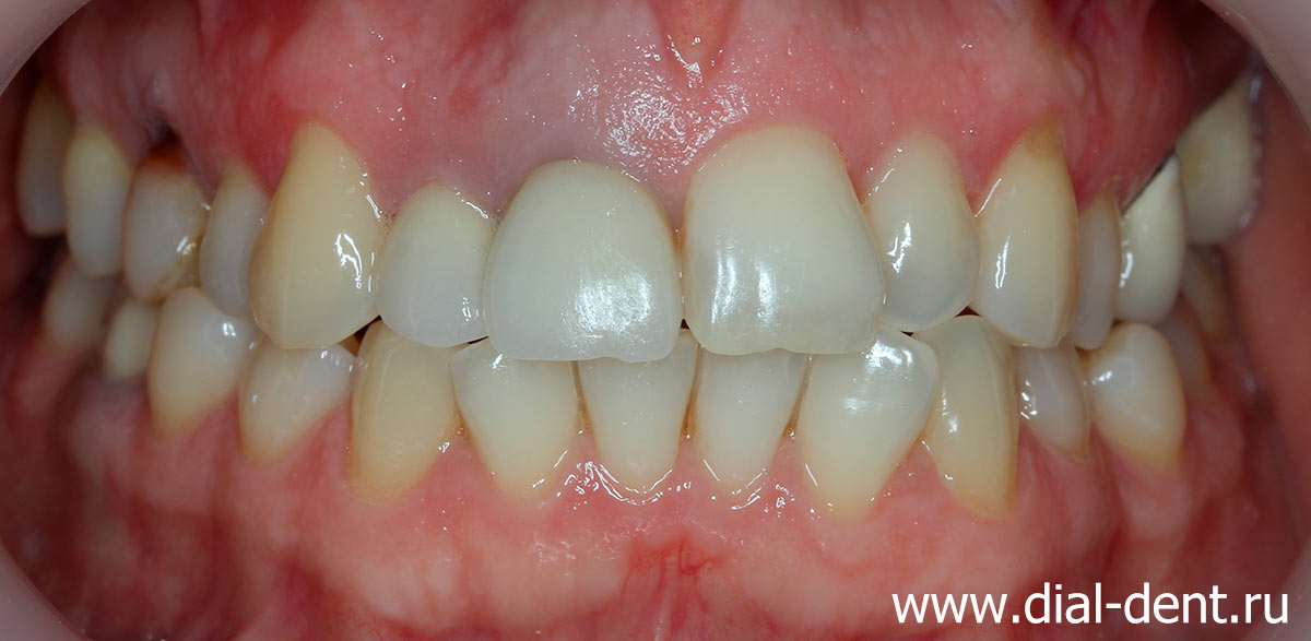до лечения: криво растут зубы, цвет зубов неровный, коронки на передних зубах неэстетичны