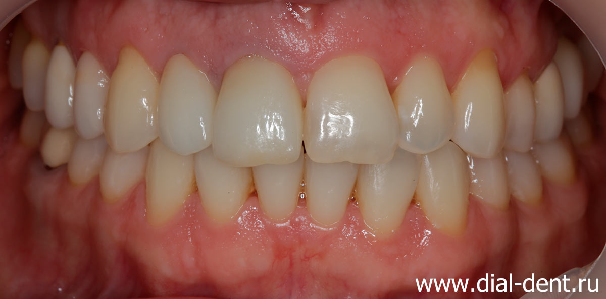 вид зубов после комплексного стоматологического лечения 