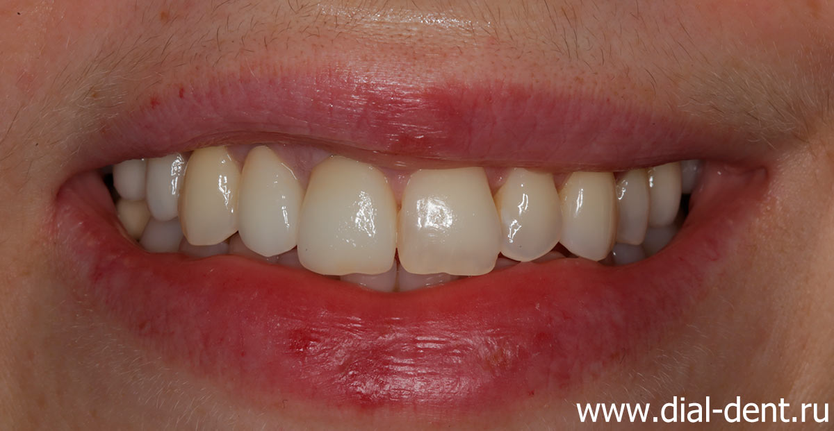 улыбка после коррекции десны и протезирования зубов