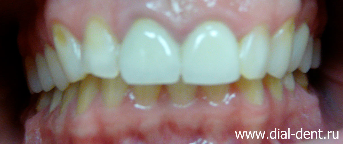 зубы до лечения - некрасивые передние зубы, клиновидные дефекты, разрушение пломб, стираемость зубов