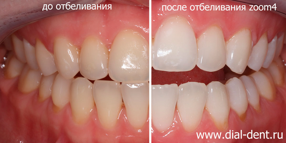 цвет зубов до и после отбеливания ZOOM 4