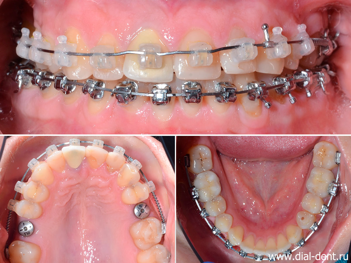 импланты Astra Tech установлены до окончания ортодонтического лечения