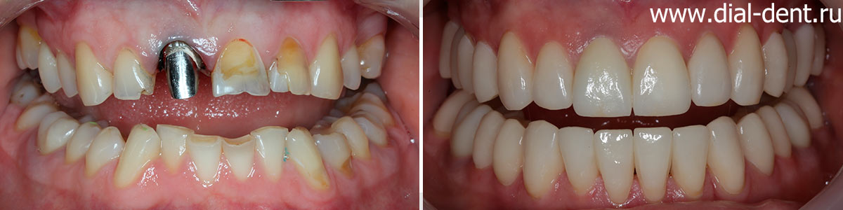 вид зубов до и после комплексного лечения с протезированием зубов