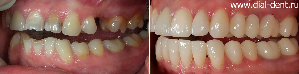 вид слева до и после комплексного лечения с протезированием зубов