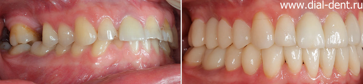 вид справа до и после комплексного лечения с протезированием зубов