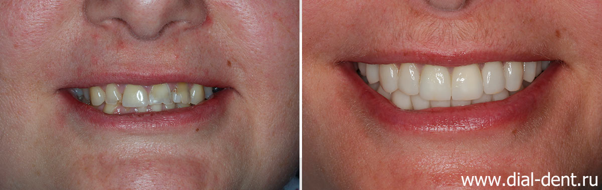 улыбка до и после комплексного лечения зубов в Диал-Дент