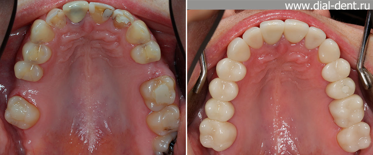 вид верхних зубов до и после комплексного лечения с протезированием зубов
