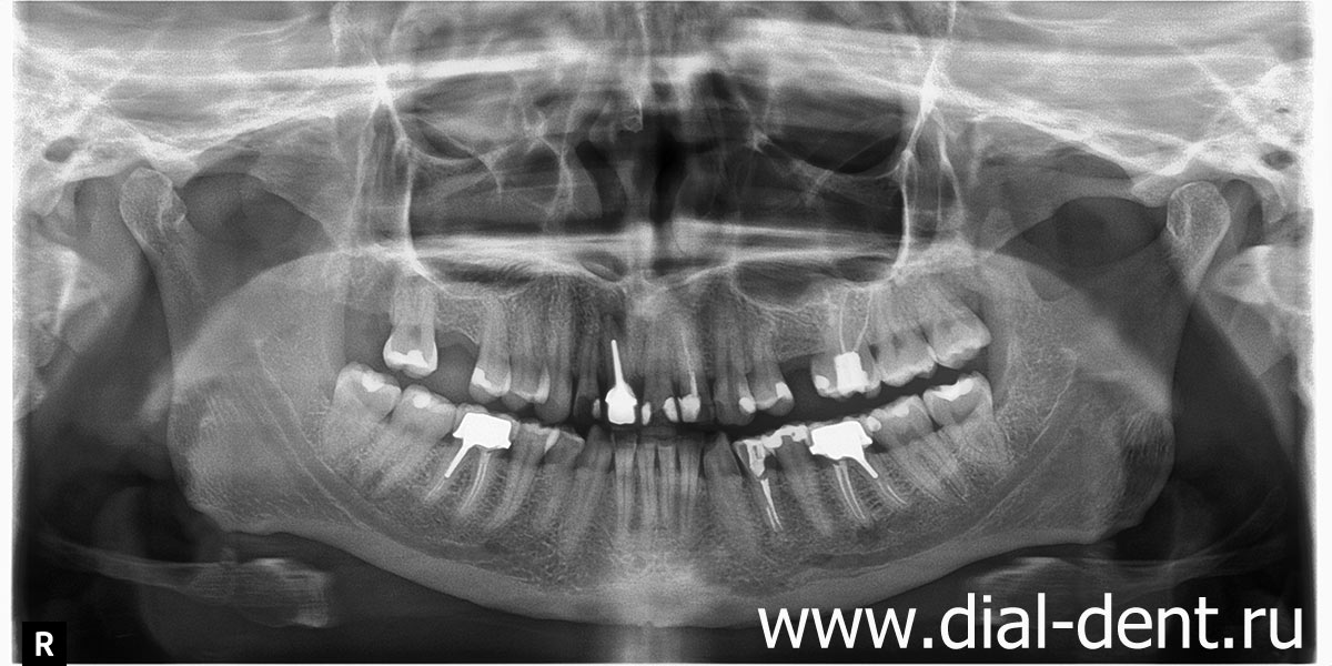 панорамный снимок зубов до лечения