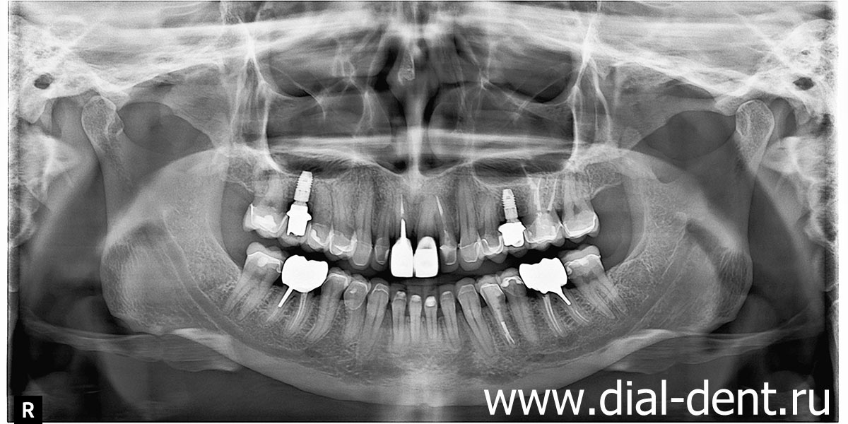 панорамный снимок зубов после имплантации и протезирования