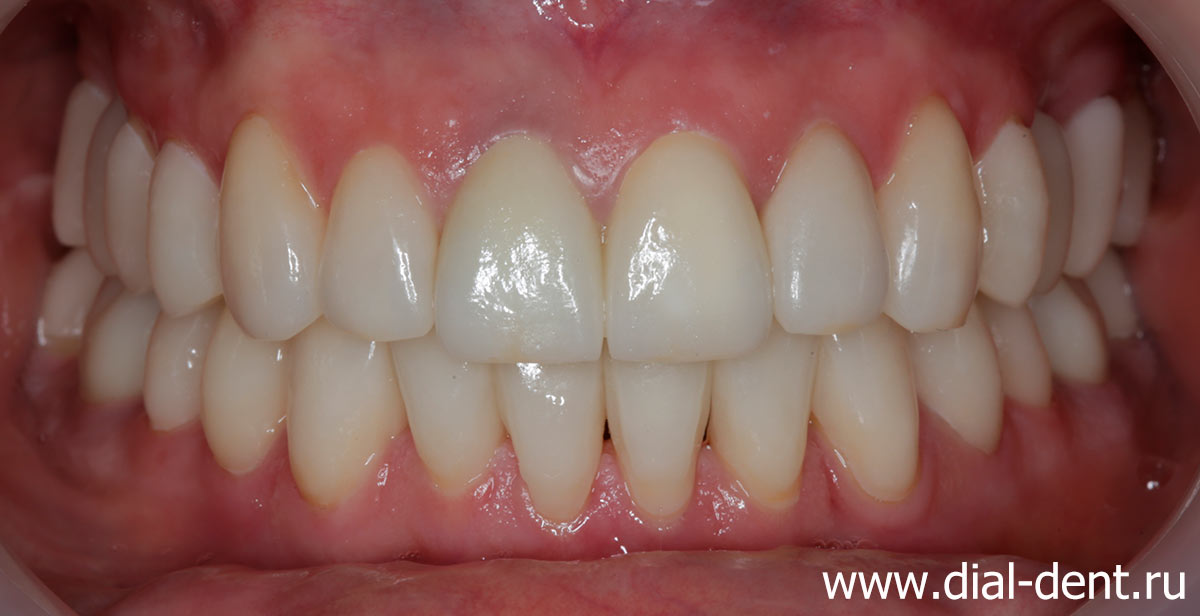 выполнено выравнивание зубов и протезирование зубов керамикой
