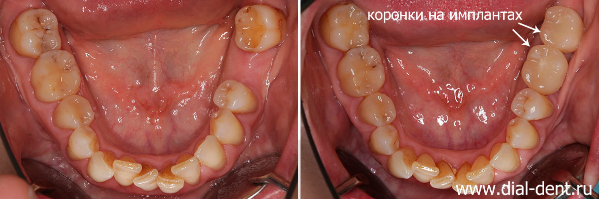 нижние зубы до и после протезирования